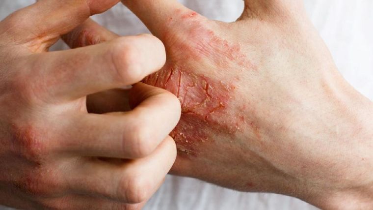 Picture of hands, with the person itching a skin allergy
